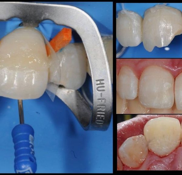 A novel method for Fragment Reattachment After Post Placement