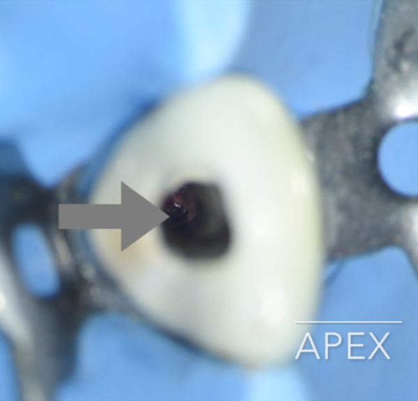 A simple trick for a sharp apical barrier placement