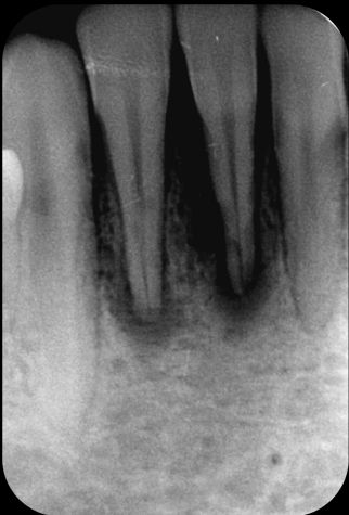 External inflammatory root resorption, how to manage?
