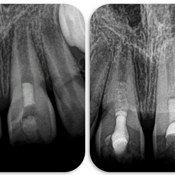 Revascularization of Immature Permanent Teeth With Apical Periodontitis