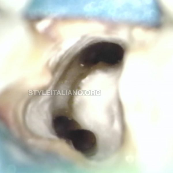 Treatment of a C shaped canal of a mandibular second molar