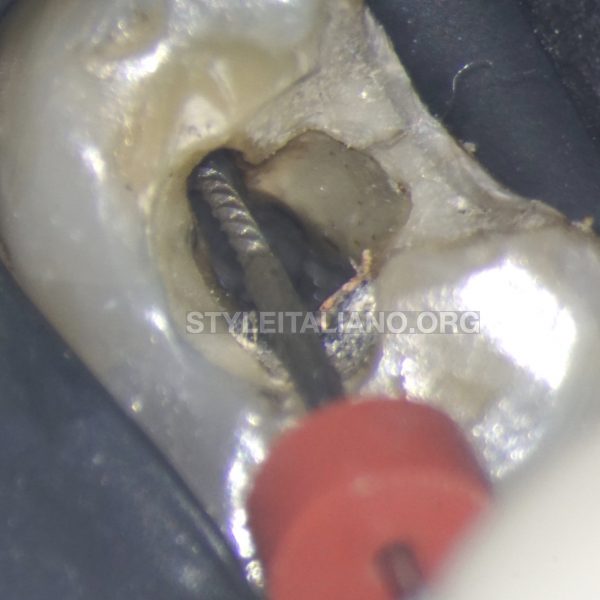 Endodontic retreatment of a maxillary second premolar with multiple shortcomings.