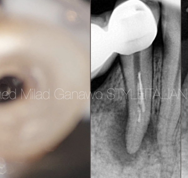 Management of the complex anatomy of a lower first premolar