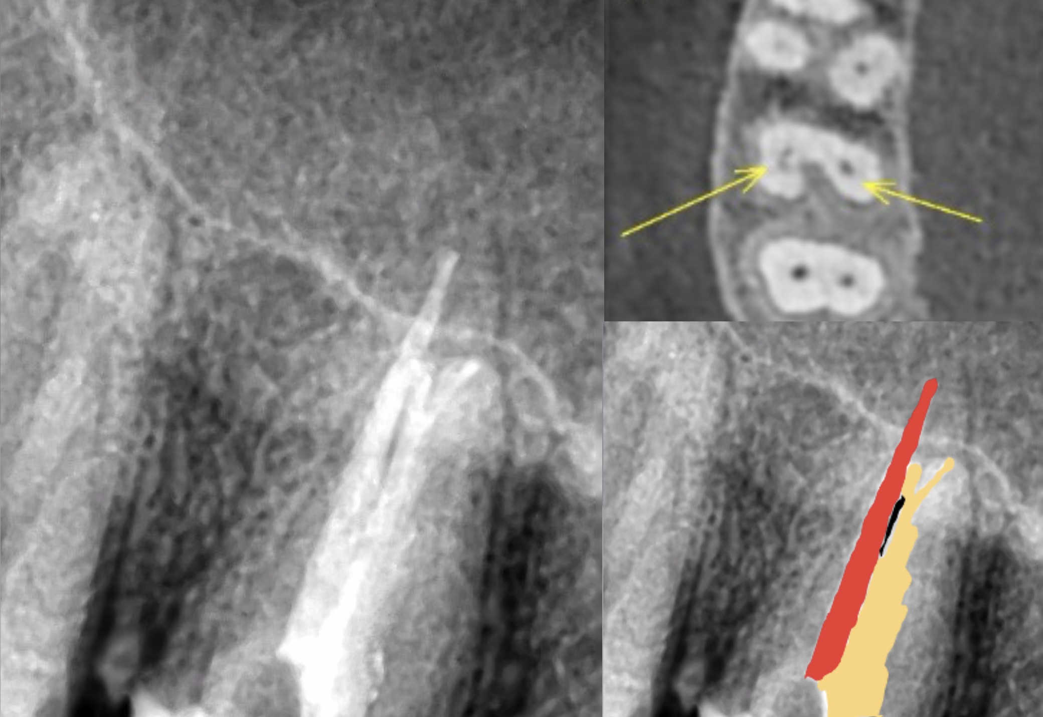 Managing a maxillary second molar with C shaped anatomy