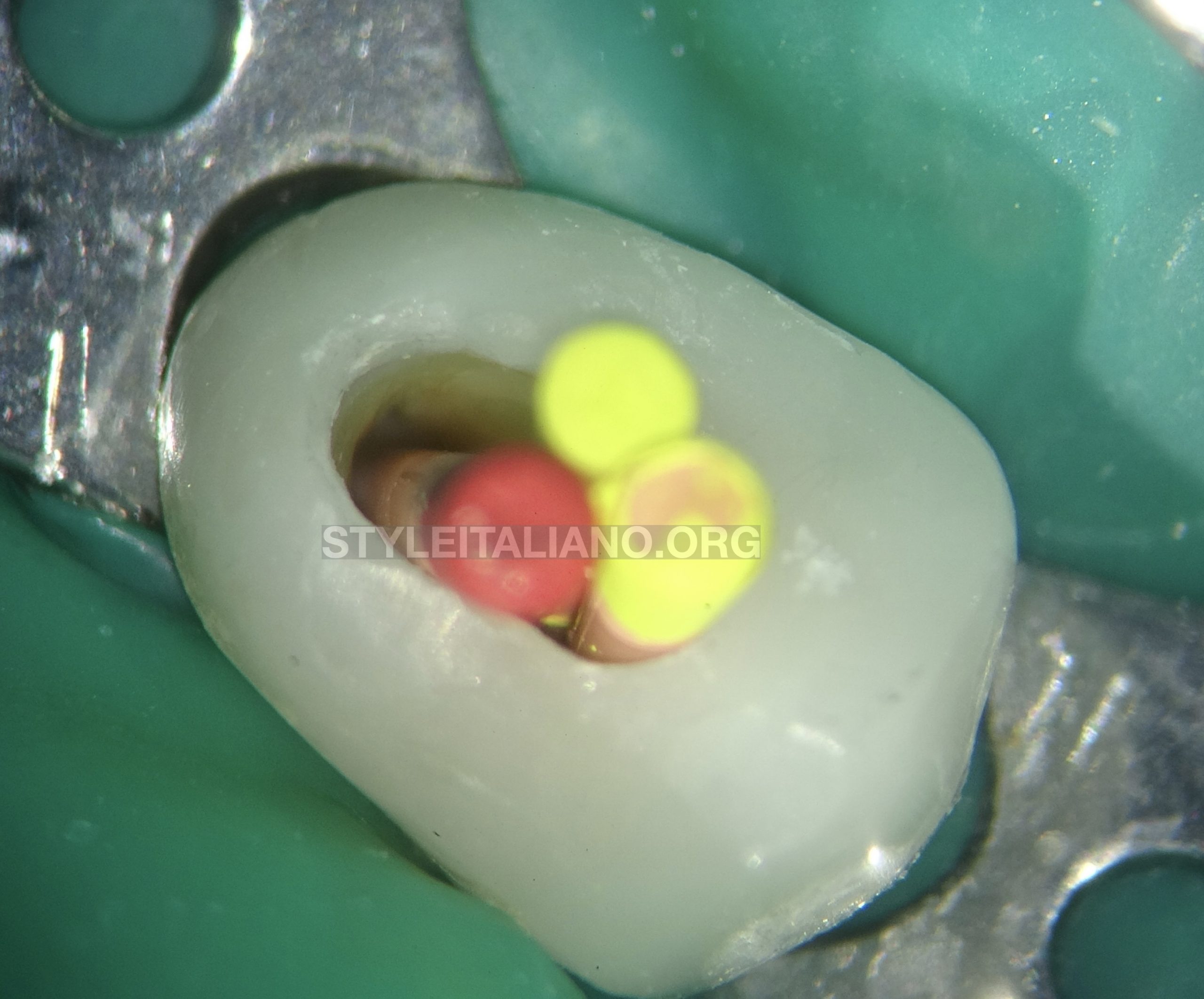 Retreatment of a maxillary premolar with missed canal
