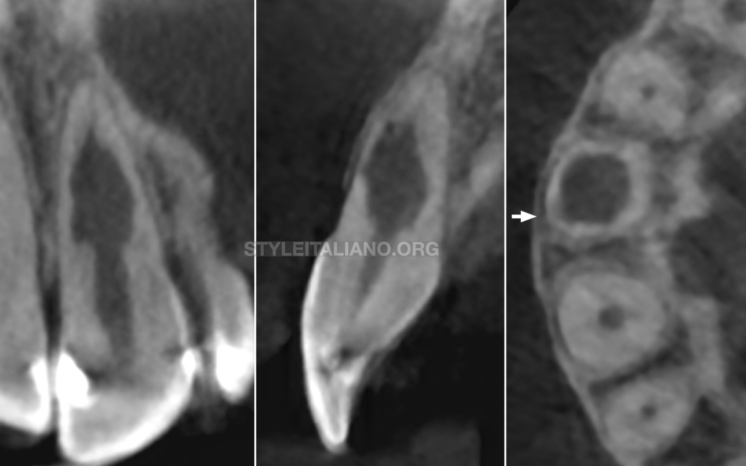 Management of a perforating internal inflammatory root resorption in a maxillary central incisor