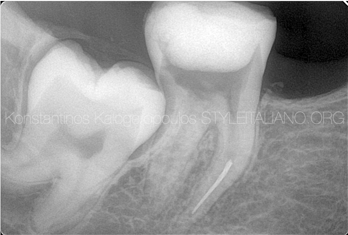 CBCT guided treatment planning and management of instrument fracture in the mesial root of a second mandibular molar