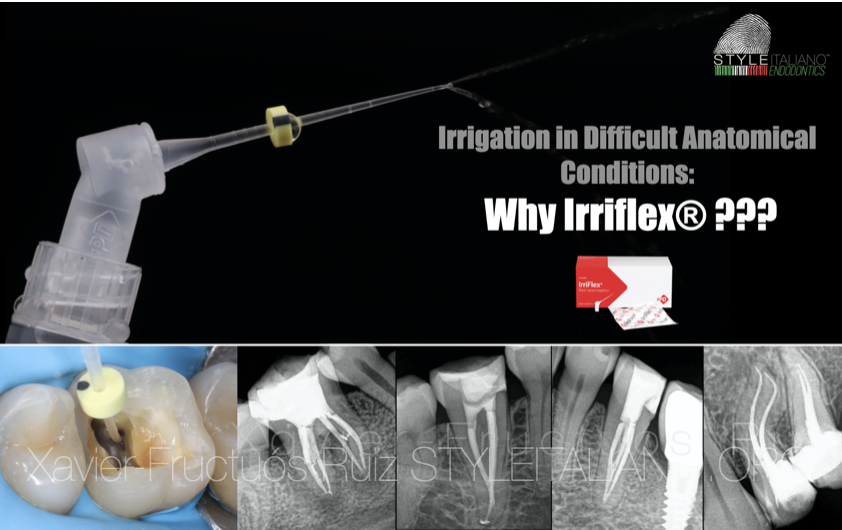 Irrigation in Difficult Anatomical Conditions: Why IrriFlex®?