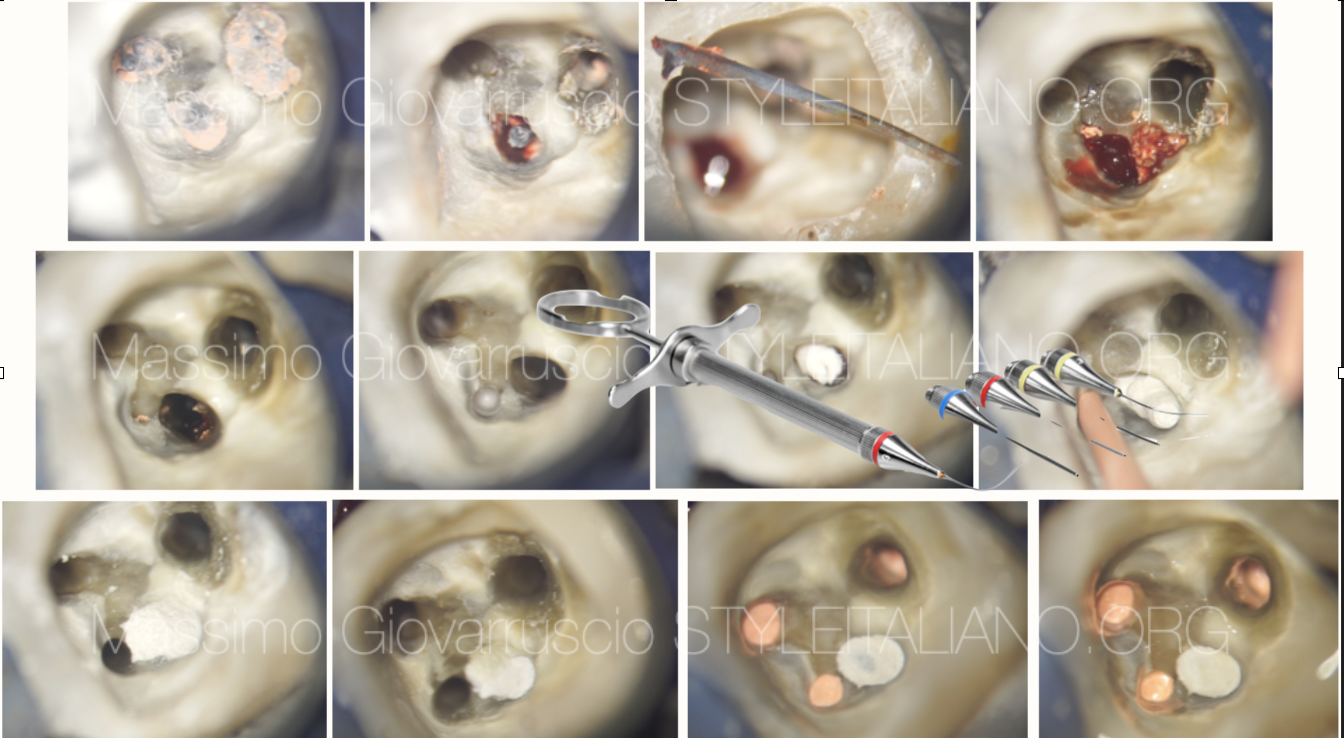 Lower second molar: carrier based obturation...through the furcation