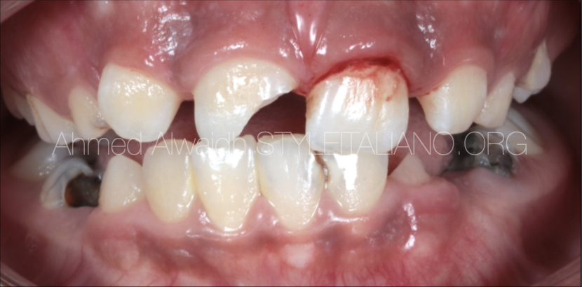 Vital Pulp Therapy: Part 1: Direct Pulp Capping for A Traumatic Exposure of Permanent Maxillary Right Central Incisor