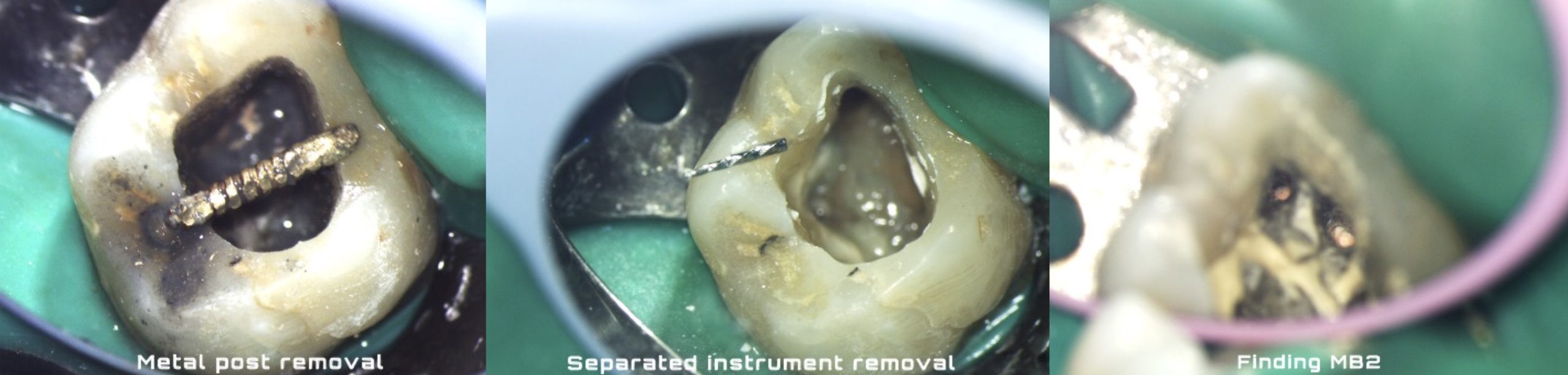 An endodontic retreatment case with multiple challenges