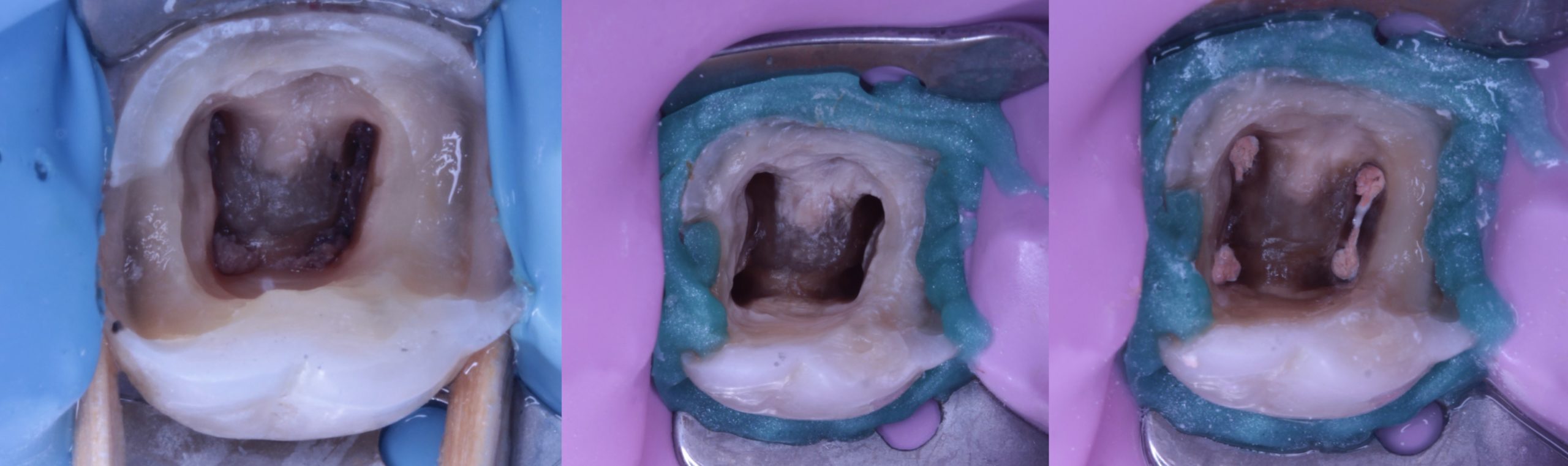 Fully Calcified Canals : Is it a Challenge ??