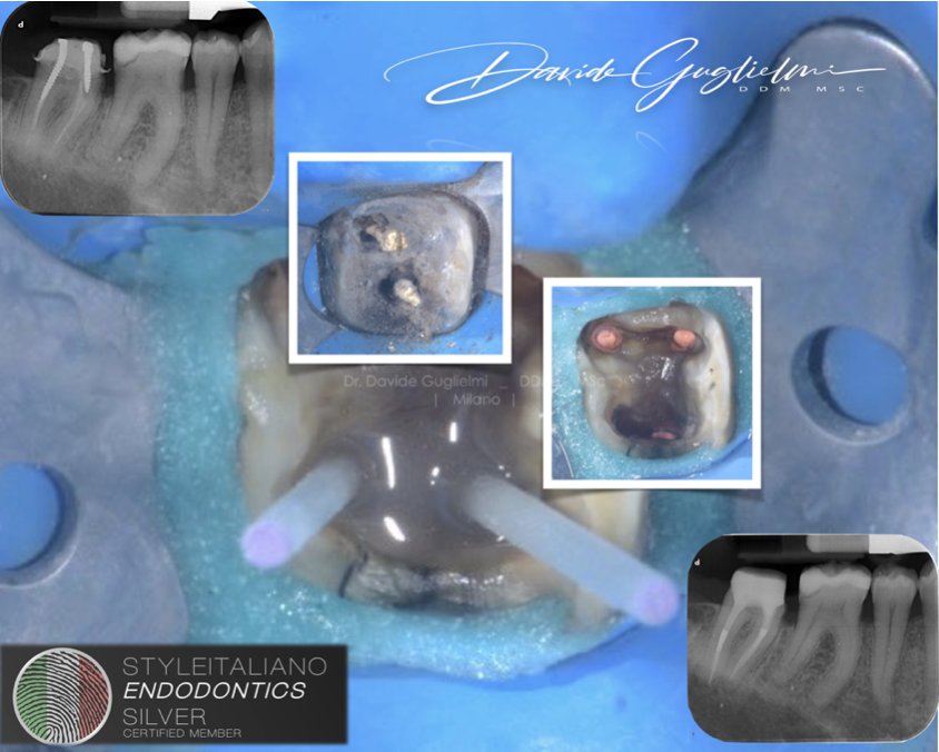 Use of Itena Dentoclic Glass Fiber Post in the Restoration of endodontically treated tooth