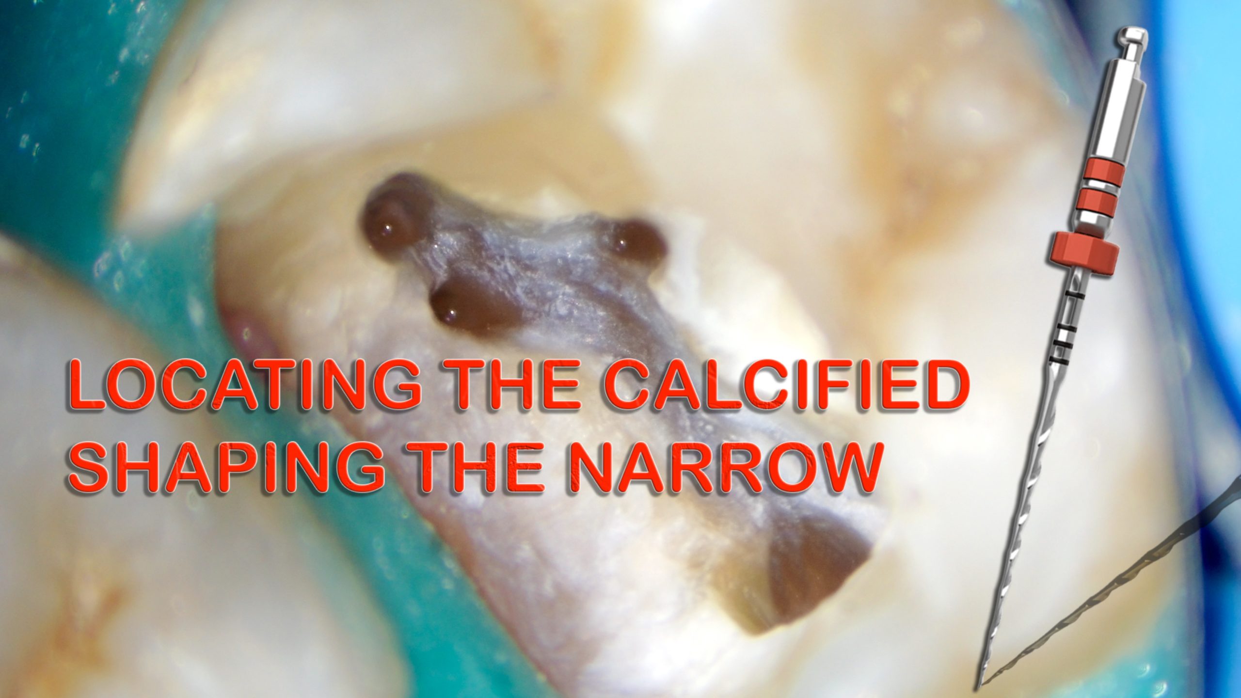 Locating the calcified - Shaping the narrow