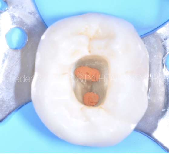 Direct restoration of  an endodontically treated tooth with Itena Reflectys composite and Quick bond adhesive system