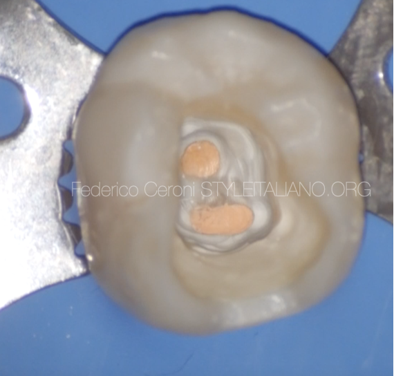 Build up and onlay preparation of an endodontically treated tooth with QuickBond adhesive system and Dentocore core build up composite