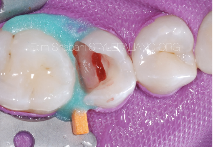 Pulpotomy in mature permanent teeth