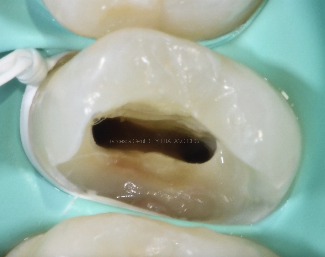 Endo-resto management of a poorly treated premolar