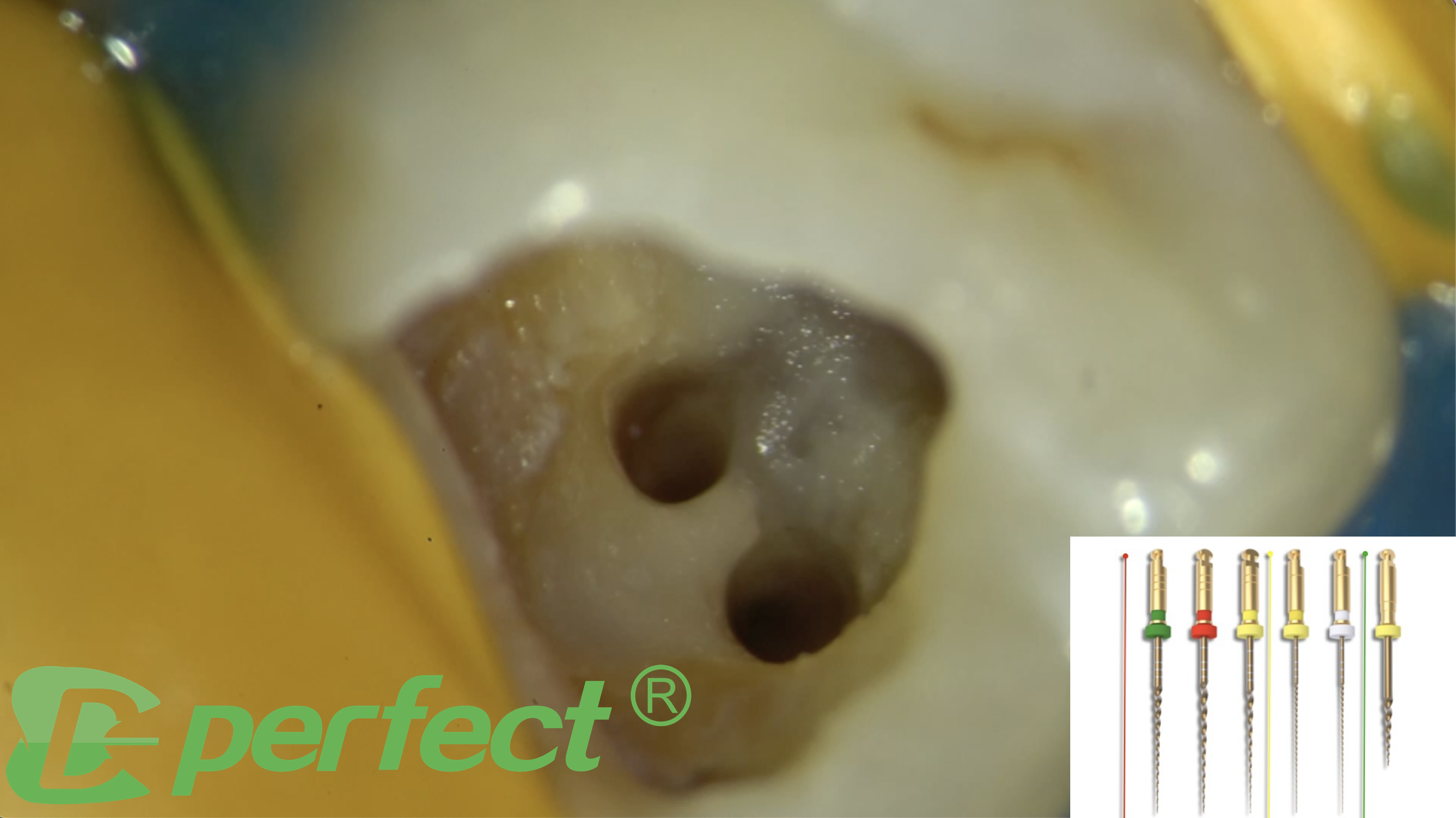 Endodontic management of a maxillary molar  with confluencing canals using MG3 files