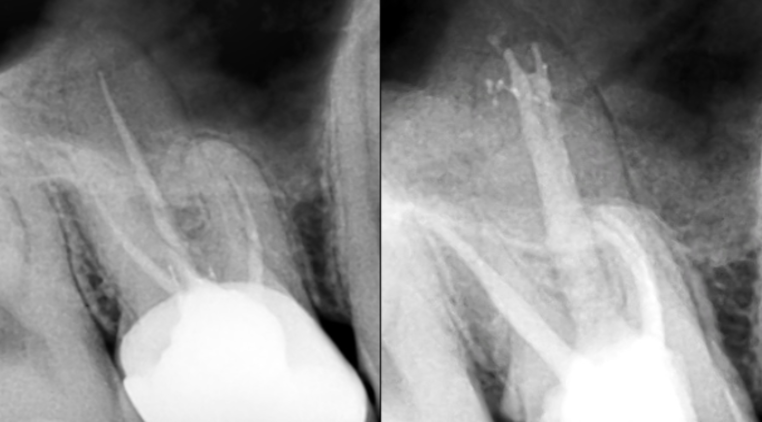 Identifying & managing varied anatomy of palatal canal in a maxillary molar- a case report with  two year follow up of retreatment of tooth number 16 with trifurcation in palatal canal.