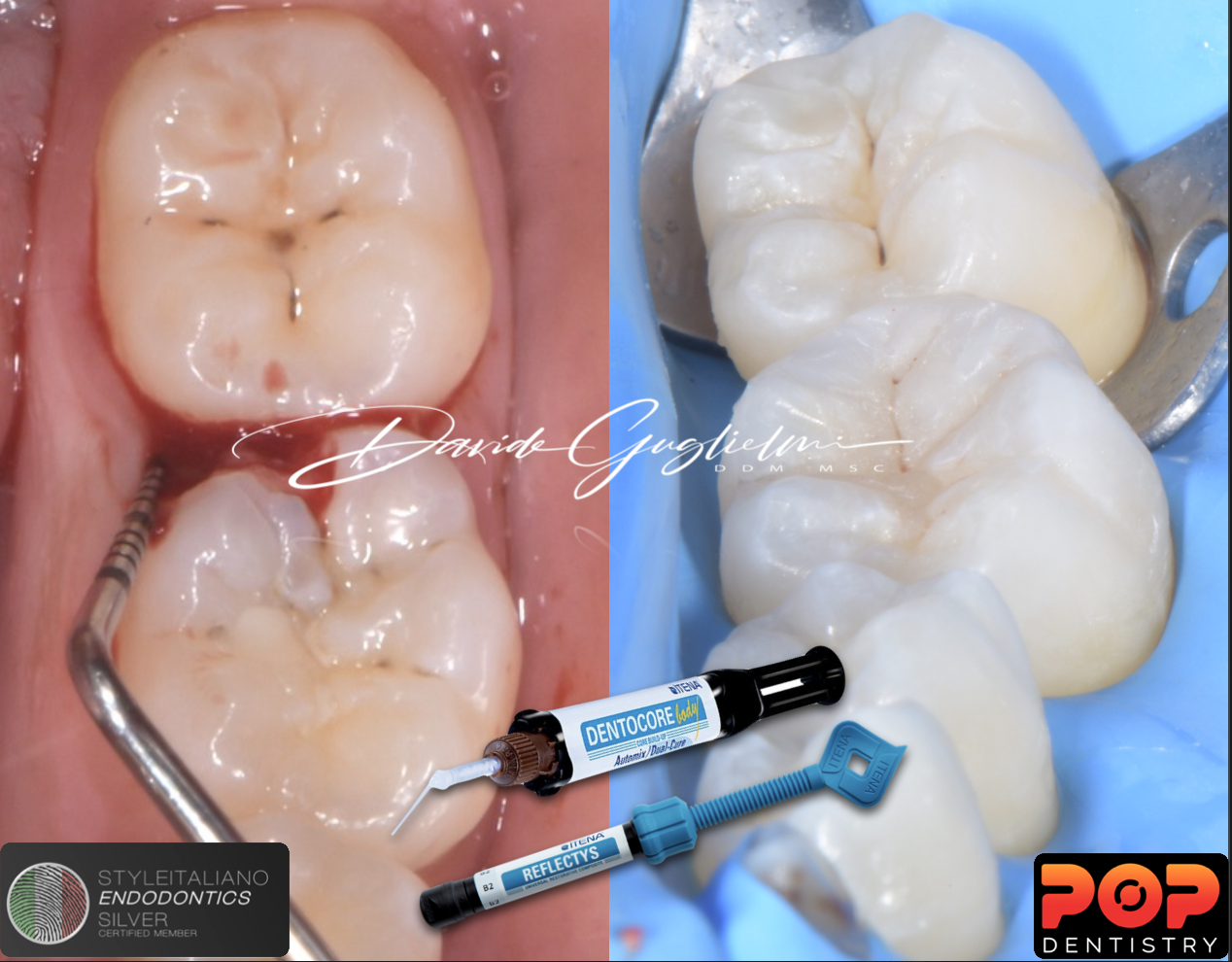 Adhesive Direct Restoration in the Posterior Area with Subgingival Cervical Margins