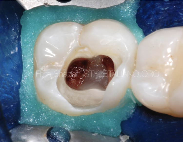 Pulpotomy in mature permanent teeth - Part II