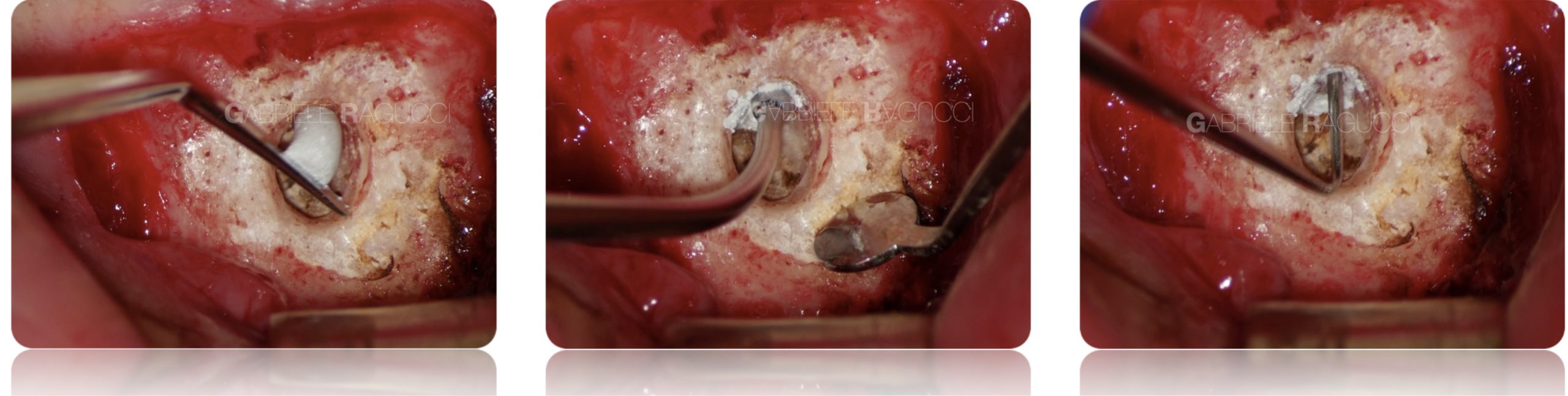 Endodontic surgery of an inferior central incisor