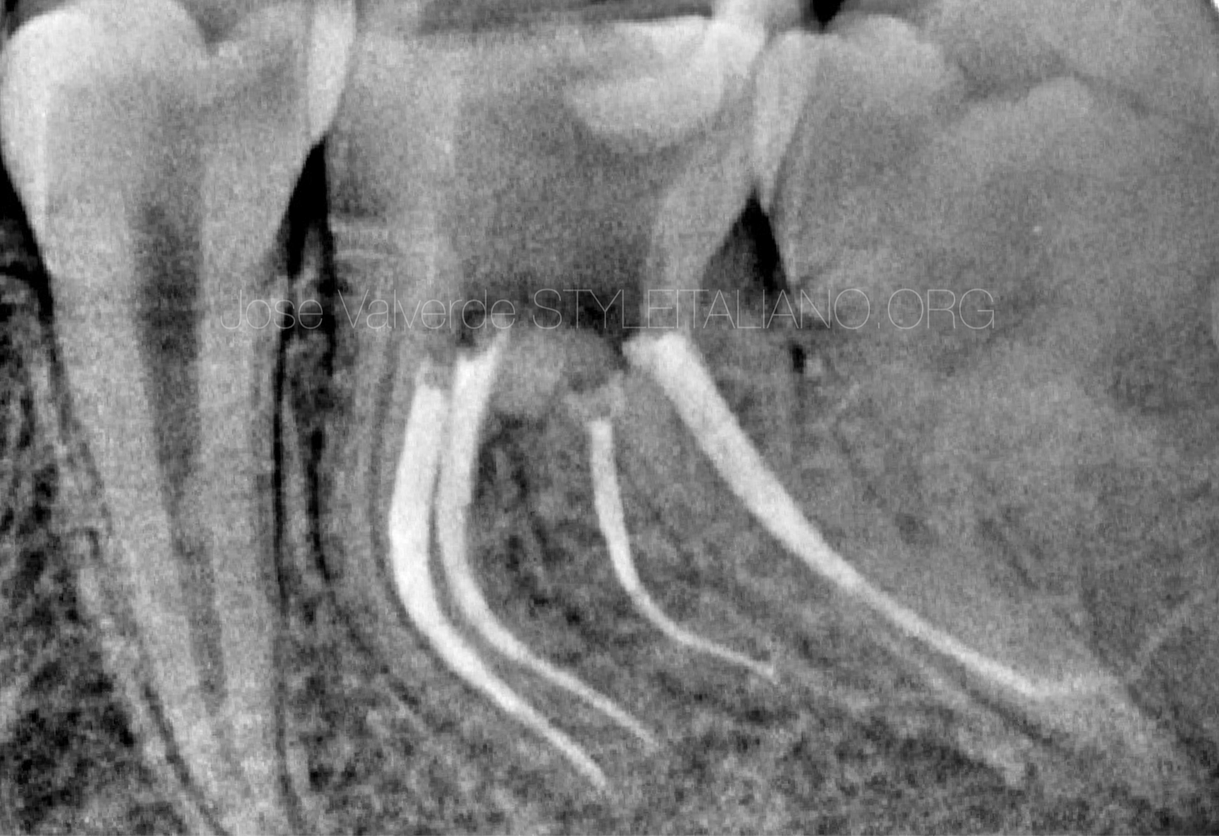 Management of a Type III Radix Entomolaris in a first lower molar