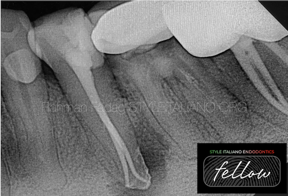 Management of deep splitting root canals