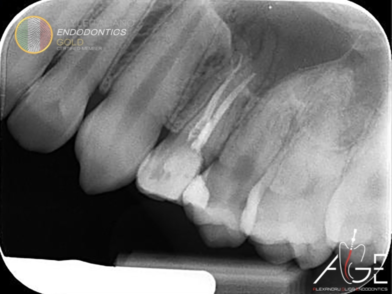 Root Canal Retreatment of UL4 using the MG3 system from Perfect: A case report 