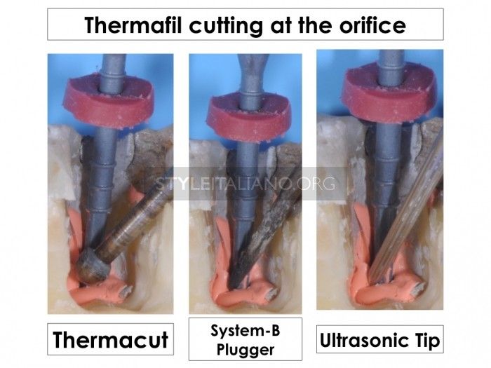 THERMAFIL: The technique step by step