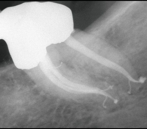 System-Based Endodontics: does your gutta percha master cone fit?