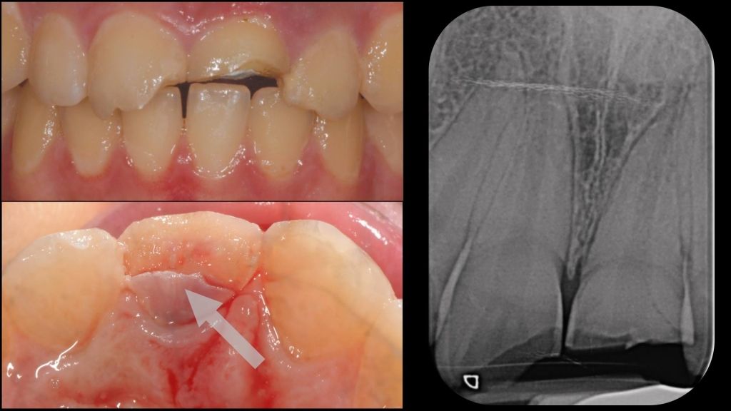 A novel method for Fragment Reattachment After Post Placement