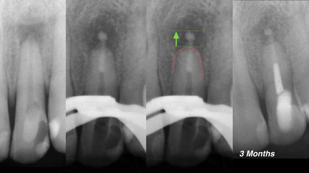 A simple trick for a sharp apical barrier placement