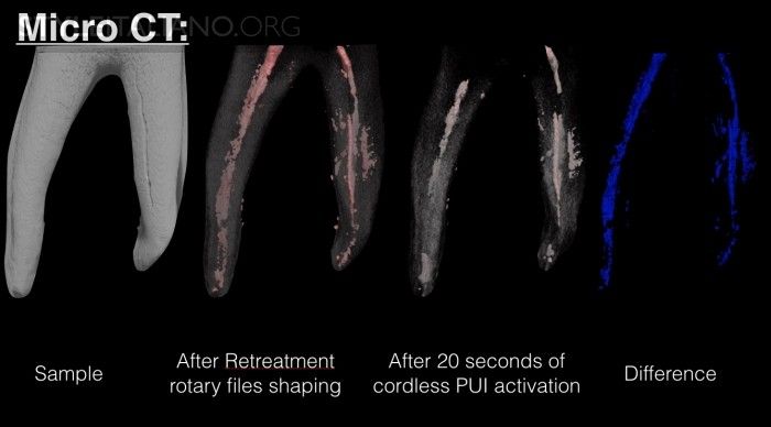 Root canal disinfection during retreatments: a cordless revolution