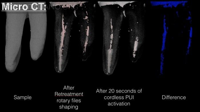 Root canal disinfection during retreatments: a cordless revolution