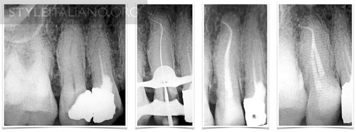 Maxillary Premolars - Part 2
