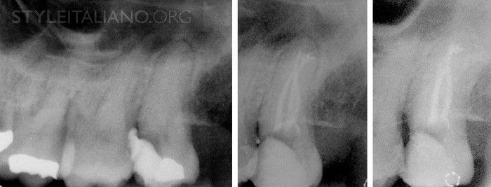 Third molars: extraction or endodontics?