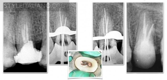 Maxillary Premolars - Part 2
