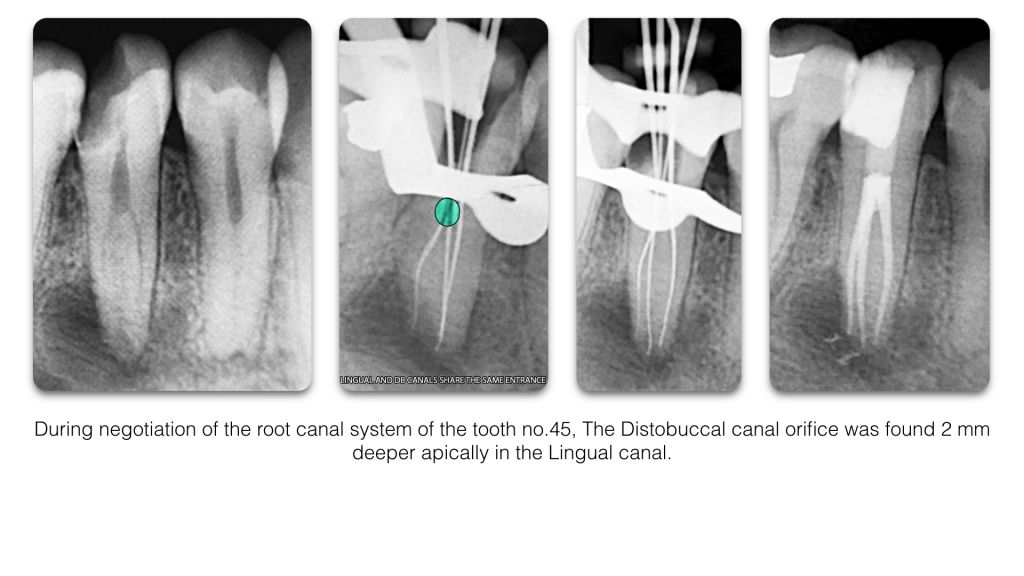 Mandibular Premolars: Teeth not to underestimate