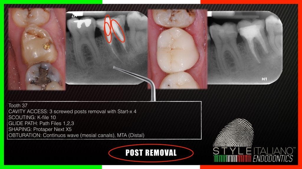 Ultrasonics in Endodontics: Part 2