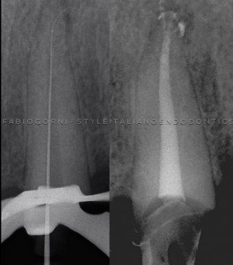 Shaping&Cleaning of the endodontic space
