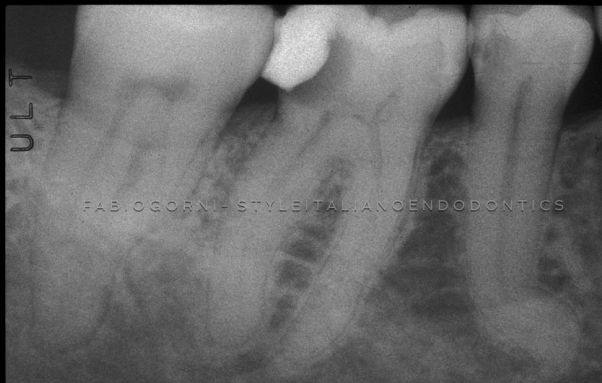 Shaping&Cleaning of the endodontic space