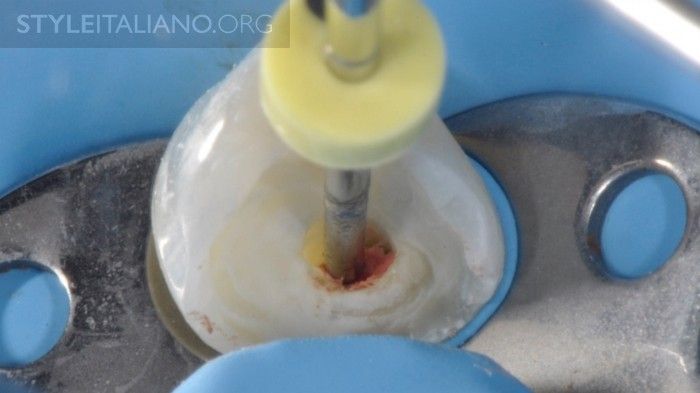 Root Canal Filling Systems: Warm Vertical Condensation