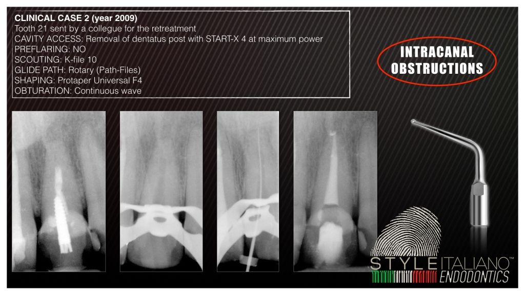 Ultrasonics in Endodontics: Part 1