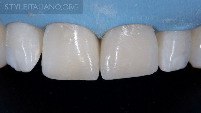 Nonvital tooth bleaching and composite restorations