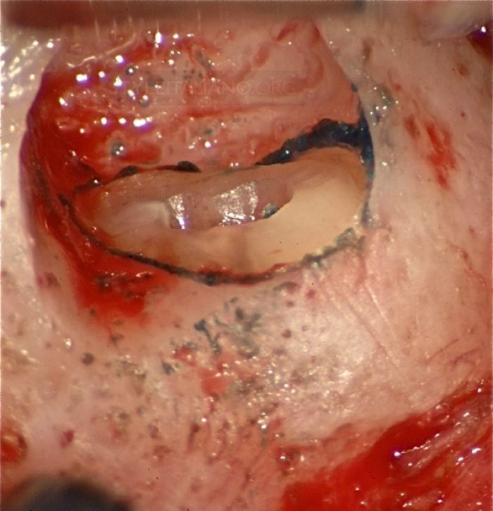 Surgical Flap in Endo Surgery – Part 1