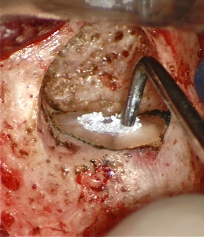 Surgical Flap in Endo Surgery – Part 1