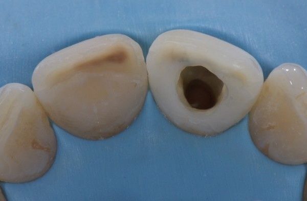 Nonvital tooth bleaching and composite restorations