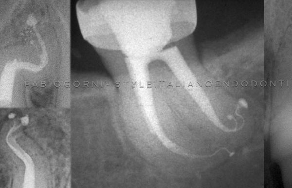 Shaping&Cleaning of the endodontic space: the Style Italiano Endodontic Philosophy and techniques